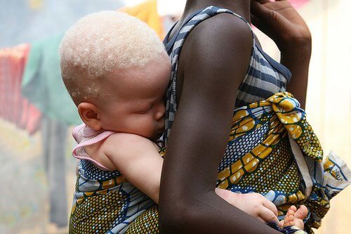 Albinismi Afrikassa