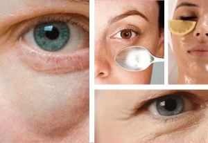 Helpot keinot silmäpussien häivyttämiseen