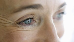 Näin häivytät ryppyjä silmien alueelta