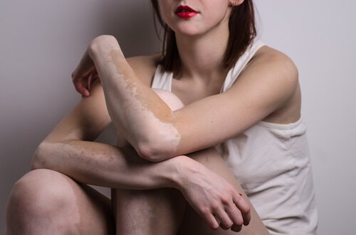 Nainen ja vitiligo