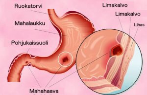 Mahahaavan hoito luonnollisesti