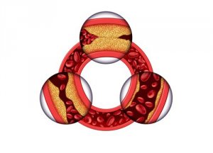 3 hoitokeinoa kaurasta kolesterolin alentamiseen