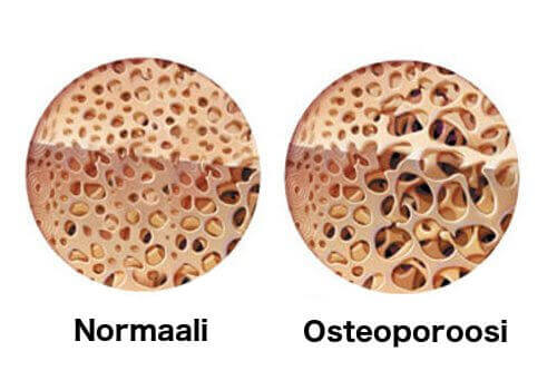 Osteoporoosi heikentää luuta.