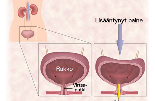 virtsankarkailu virtsarakon ollessa täysi