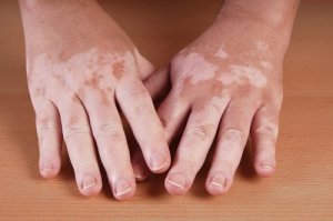 5 tapaa hoitaa vitiligoa kotikonstein