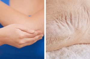 Pehmitä kuivat kyynärpäät ja jalat yhdessä viikossa