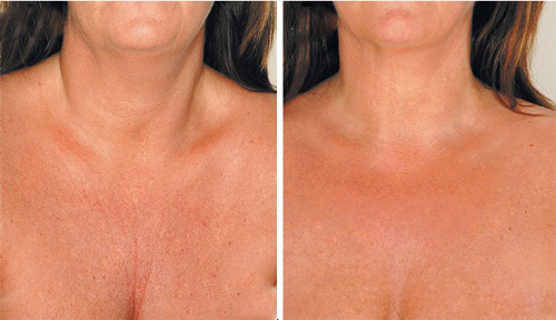 painovoima ja ikääntyminen aiheuttavat ryppyjä