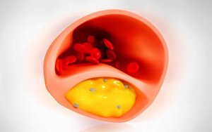 8 ruokaa valtimoiden puhdistamiseen