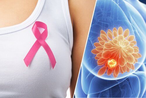 10 rintasyövän varoitusmerkkiä
