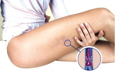 Valtimonkovettumatauti raajoissa voi oireilla mm. suonikohjuina.