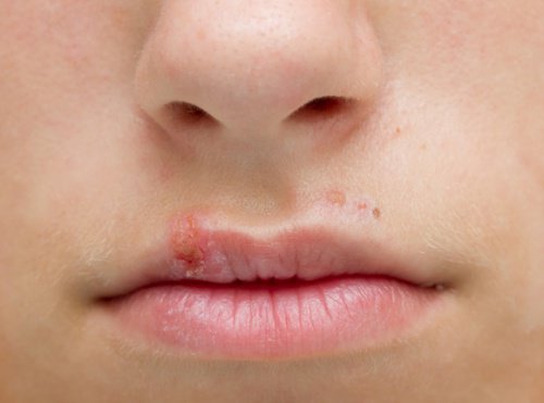 huuliherpes