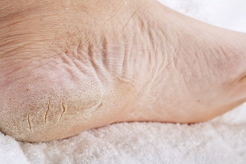 8 keinoa päästä eroon halkeilevista kantapäistä 8 keinoa päästä eroon halkeilevista kantapäistä