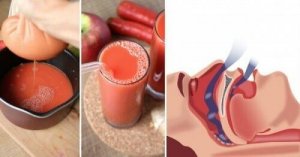 Luonnollinen apu kuorsaukseen ja uniapneaan