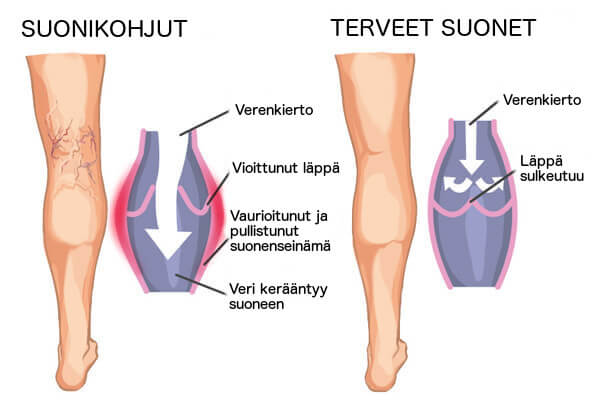 Suonikohjut ja hämähäkkisuonet kuriin kotikonstein