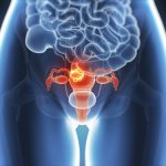 Endometrioosin riskit ja oireet