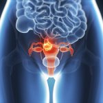 Endometrioosin riskit ja oireet