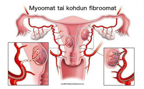 Kohdun fibroomat: 5 asiaa, jotka sinun tulee tietää