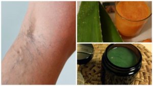 Klassikkohoito suonikohjuille