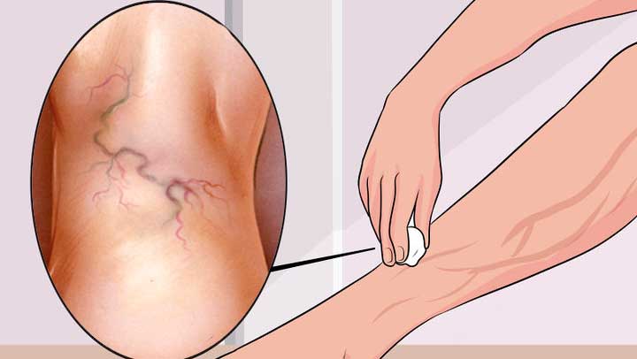 Fenkolitee auttaa jalkojen nesteturvotus