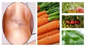 3 ainesosan luonnollinen hoito suonikohjuille