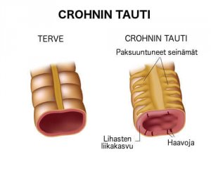 Crohnin taudin hoito oikealla ruokavaliolla