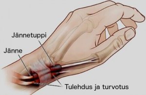 Hoida jännetuppitulehdus ajoissa