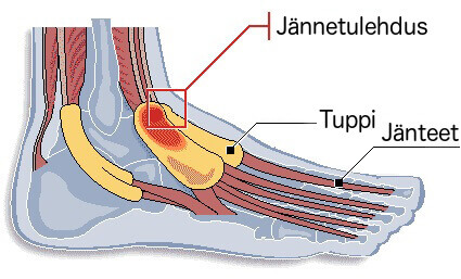 jannetuppitulehdus jalassa
