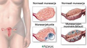 9 tärkeää faktaa munasarjojen kystista