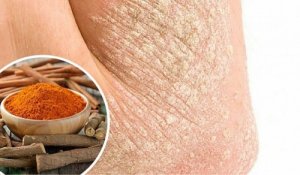 7 luonnollista tapaa torjua psoriasista