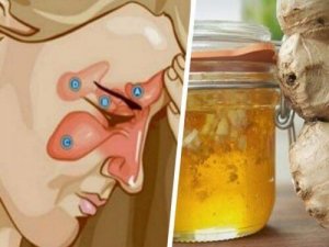 Lievennä poskiontelotulehduksen oireita inkiväärillä ja omenaviinietikalla