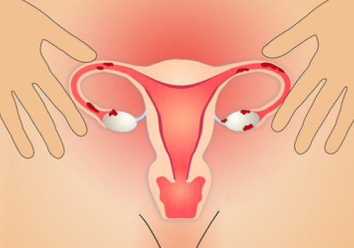 endometrioosista johtuvat verihyytymät