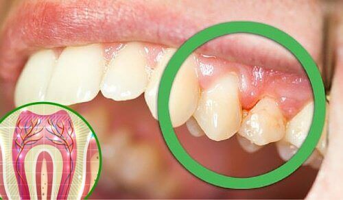 6 syytä hammaskivulle
