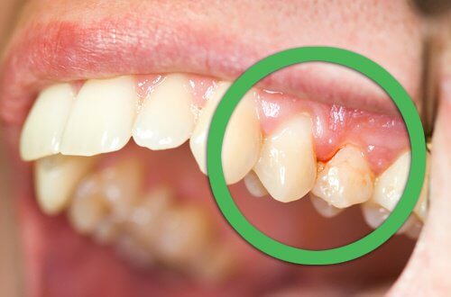 6 syytä hammaskivulle: ientulehdus