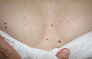 Punaiset pisteet iholla - ovatko ne vaaraksi?