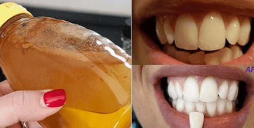 Valkaise hampaat luonnollisesti omenaviinietikalla