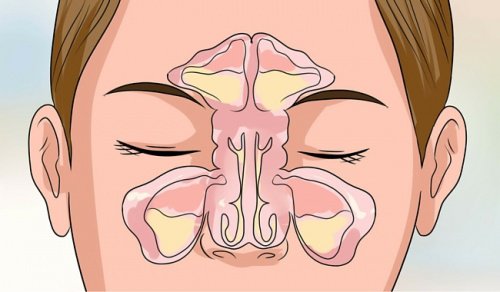 6 vinkkiä nenän tukkoisuuden helpotukseen