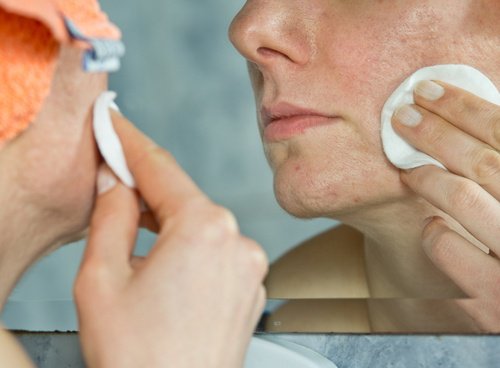 Luonnollinen voide aknearville