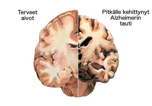 Alzheimer on salakavala sairaus, joka vaikuttaa aivoihin.