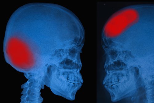 Aivohalvauksen merkit röntgen