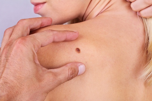 7 asiaa, joita et tiennyt ihosyövästä