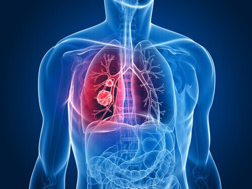 Keuhkosyöpä on yksi yleisimmistä syövistä naisilla.