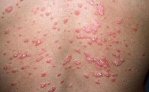 Psoriasis – mikä se on ja mitä eri muotoja sairaudella on?