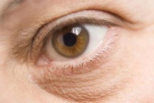10 stressin haitallista vaikutusta ulkonäköösi - silmäpussit.