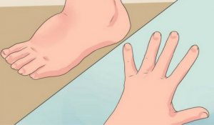 5 helppoa tapaa vähentää nesteen kertymistä