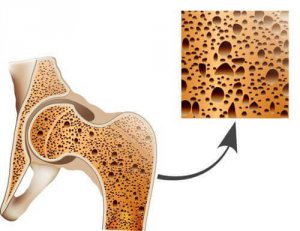 Taistele osteoporoosia vastaan näillä luonnollisilla keinoilla