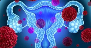 Toksinen shokkioireyhtymä - ole varovainen tamponien kanssa!