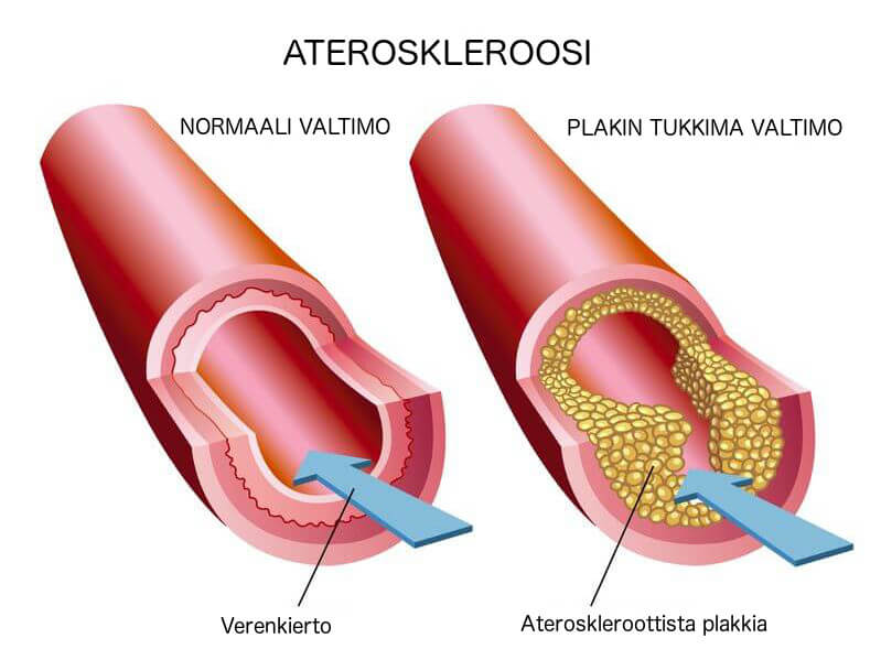 Ateroskleroosi