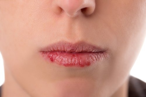 Nielusyöpä – mitä oireita sillä on? Nielusyöpä – mitä oireita sillä on?