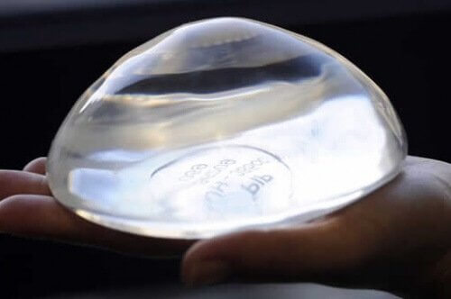 rintaimplantti voidaan asettaa mastektomian jälkeen