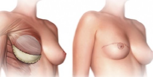 Tämä sinun tulisi tietää rinnanpoistoleikkauksesta